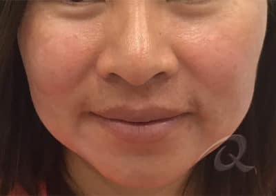 Acne Treatment Before After Pictures
