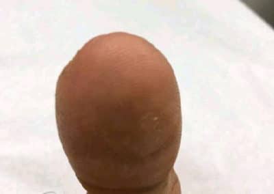 Wart Before & After Pictures