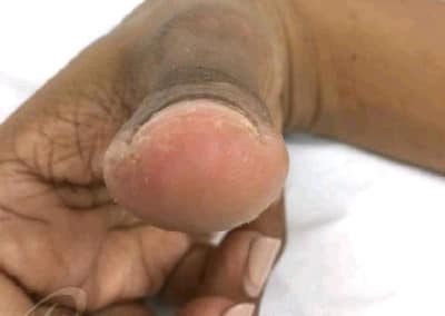 Wart Removal Before & After Pictures