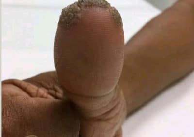 Wart Before & After Photo