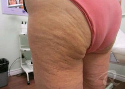 Cellulite Treatment Before & After Pictures