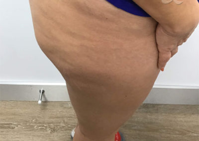 Cellulite Before & After Pictures #22