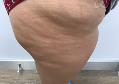 Cellulite Treatment Before & After Pictures 22