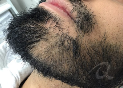 Hair Loss Before After Photo 31
