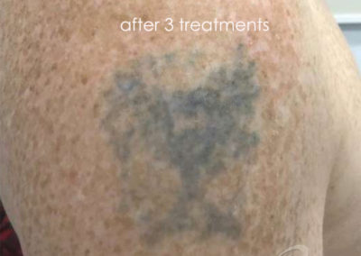 Tattoo Removal Before & After Pictures