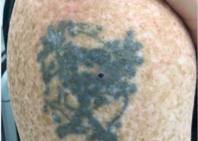 Laser Tattoo Removal Before Photo