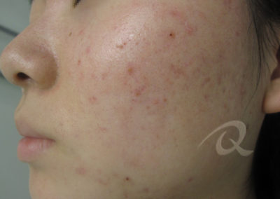Acne Before & After Photos