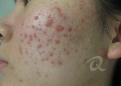 Acne Before & After Pictures 50