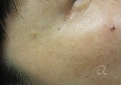 Age Spots Before & After Photo
