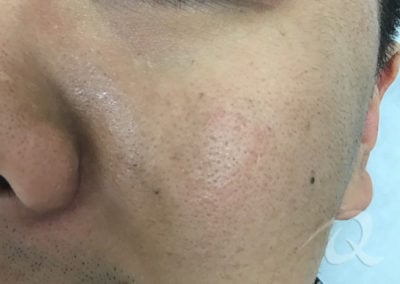 Birthmark Before & After Photo 51