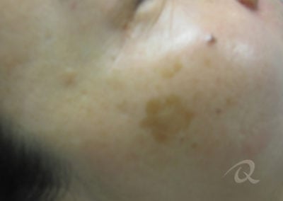 Age Spots Before & After Photos