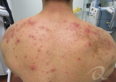 Back Acne Before After Picture
