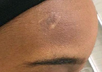 Birthmark Before & After Pictures