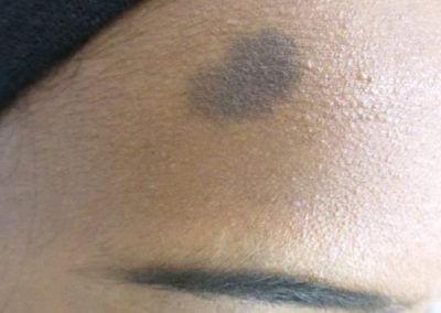 Birthmark Before & After Photos