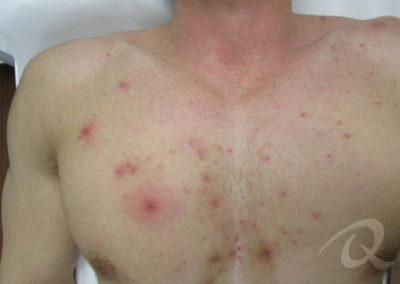 Chest Acne Before & After Pictures