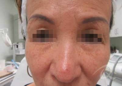 Dark Circles Before & After Pictures