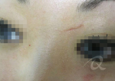 Scar Removal Before & After Photos