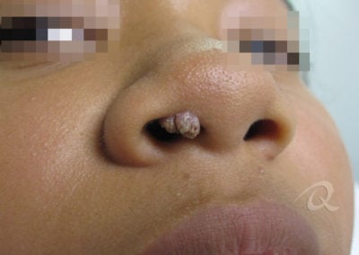 Wart Removal Before & After Photo