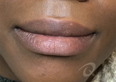 pigmentation removal after picture