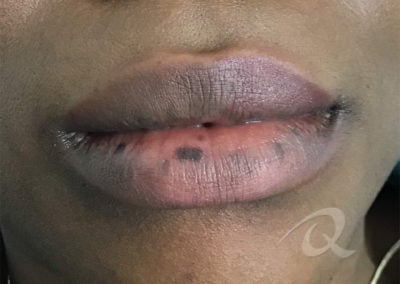 pigmentation removal before picture