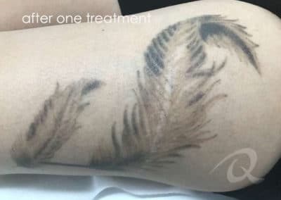 tattoo removal after picture
