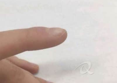 Wart removal after picture
