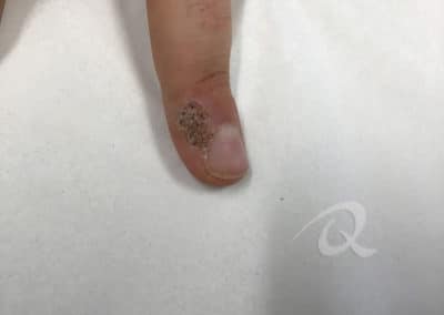 Wart removal before picture