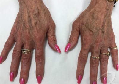 Age spot removal photos