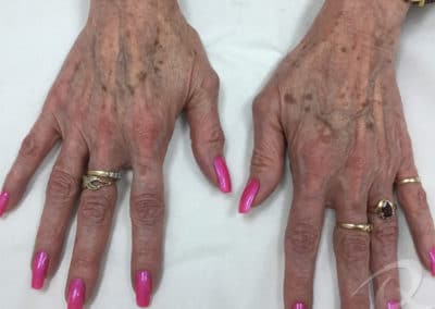 Age spot removal before/after photo