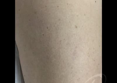 Laser Vein Removal Before & After Photos a1