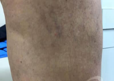 Laser Vein Removal Before & After Pictures