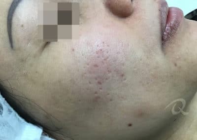 Acne Scar Before & After Pictures b1-1