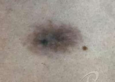 Birthmark Treatment Before & After Pictures