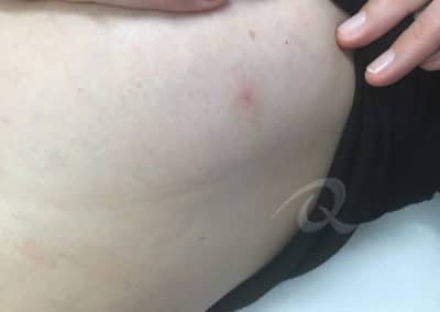 Birthmark Removal Before & After Picture aa11