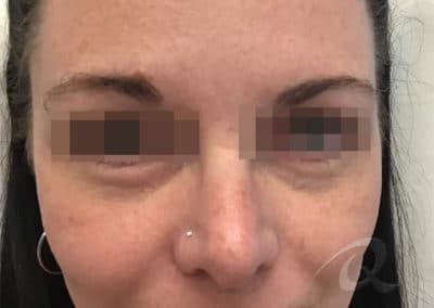 Dark Circles Before & After Pictures b1