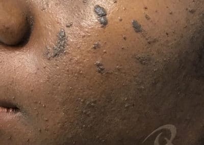 wart removal before photo b5