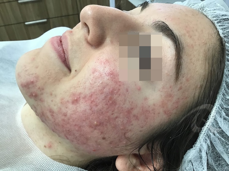 Acne Before & After Picture 55-b1.