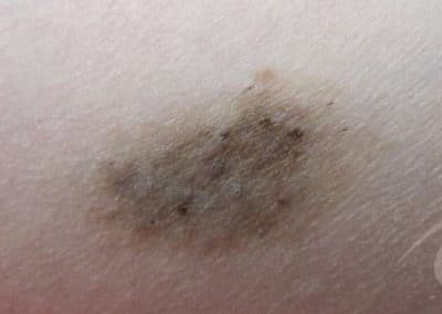 Birthmark Before & After Picture b6