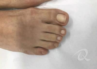 Fungal Nail Treatment Before & After Picture a5