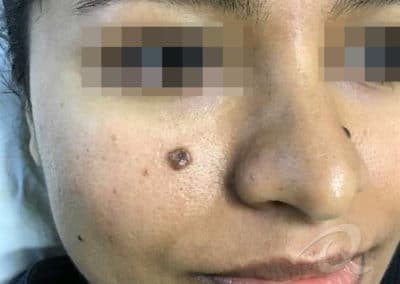 Mole Removal Before & After Picture b4