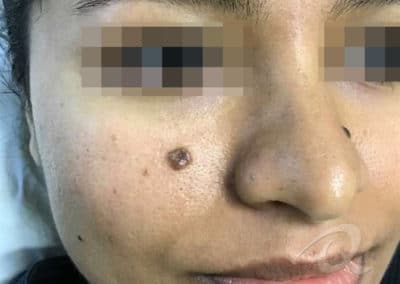 mole removal cream before and after