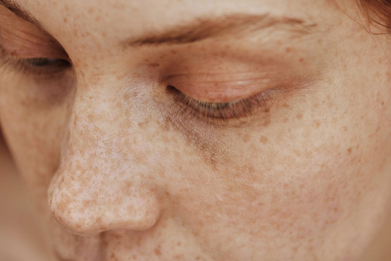 Female face with freckles fat reduction treatment toronto